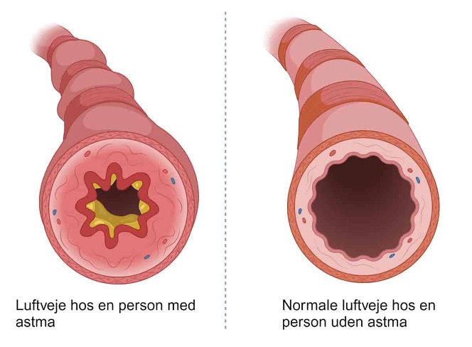 astmatisk bronkitis