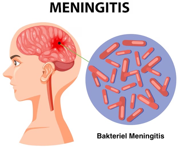 bakteriel meningitis