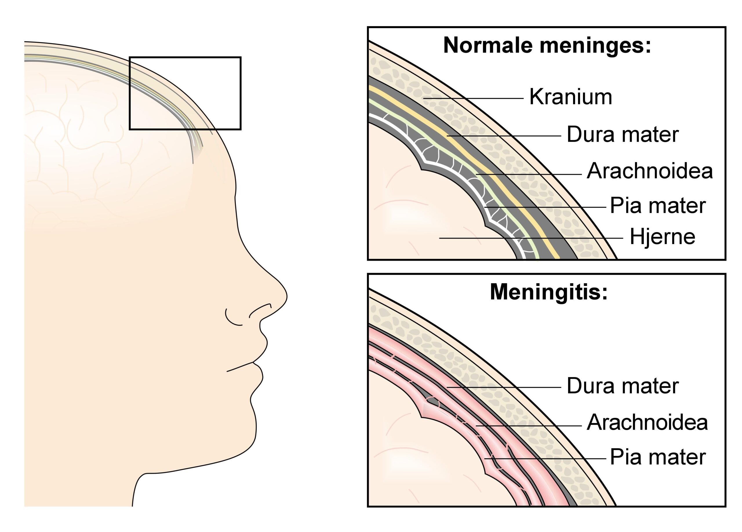 hjernehindebetændelse