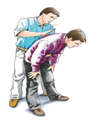 Heimlich manøvren Sådan udfører du Heimlich manøvren