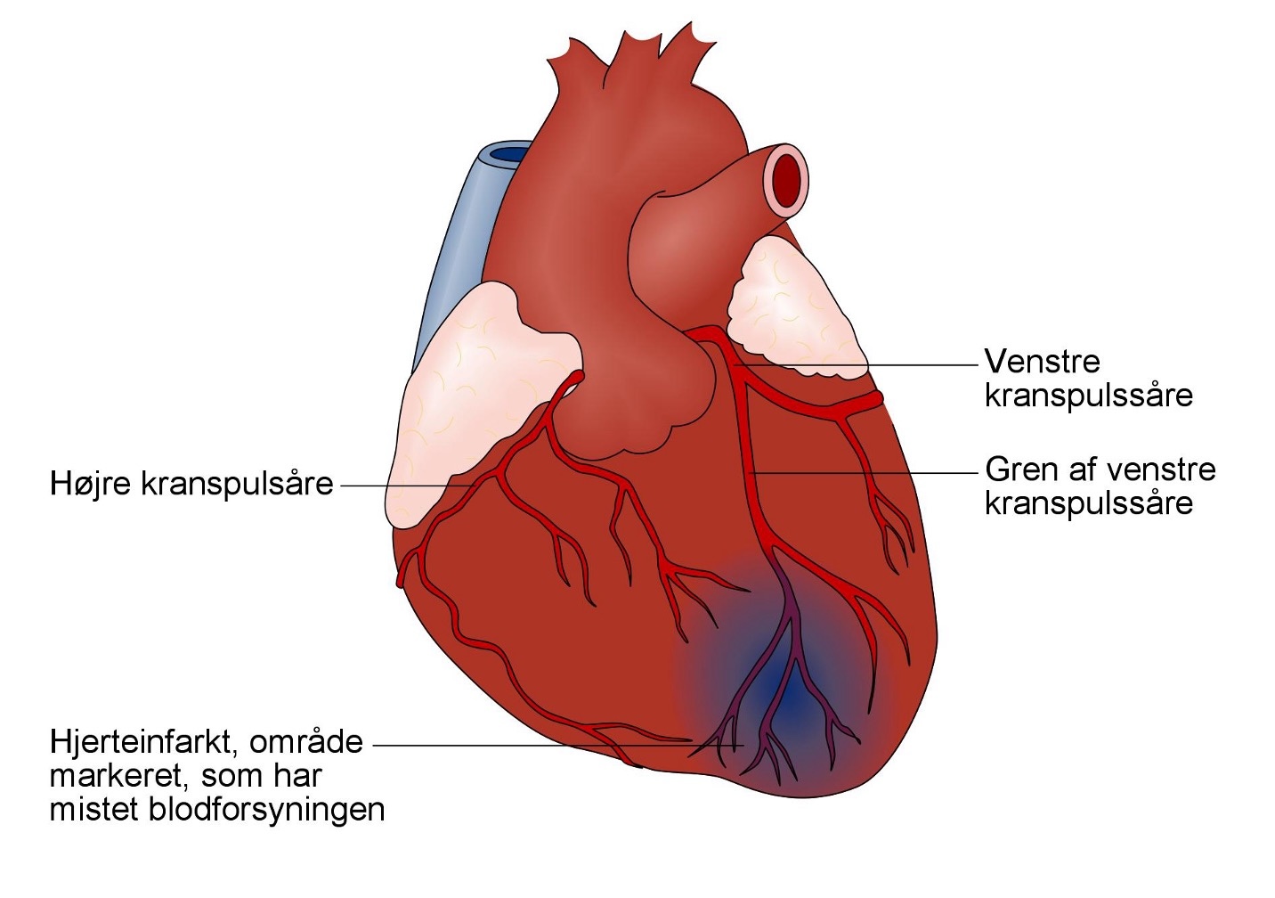 blodprop i hjertet blodprop i hjertet