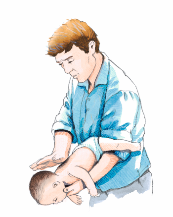 heimlich udført til baby